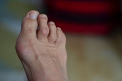 Symptoms and Treatment of Hammertoes