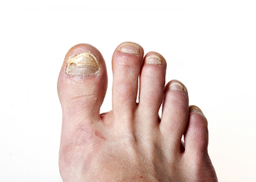 The truth about discolored toenails