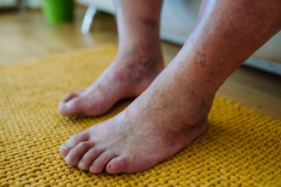 Recognizing Signs of Diabetes in the Foot